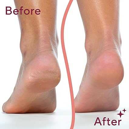 Callus Remover