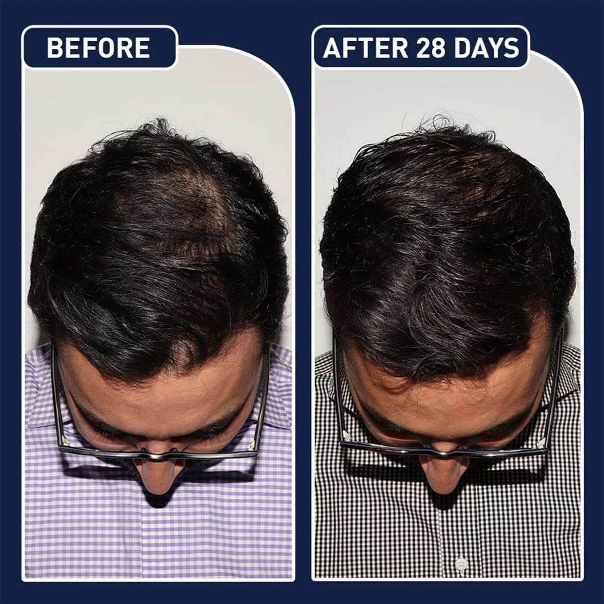 FEG Plus Hair Growth Spray  – Anti Hair Loss for Men & Women