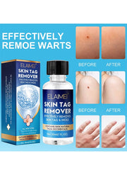 Skin Tag Remover