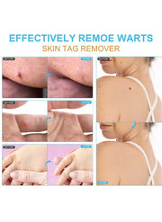 Skin Tag Remover